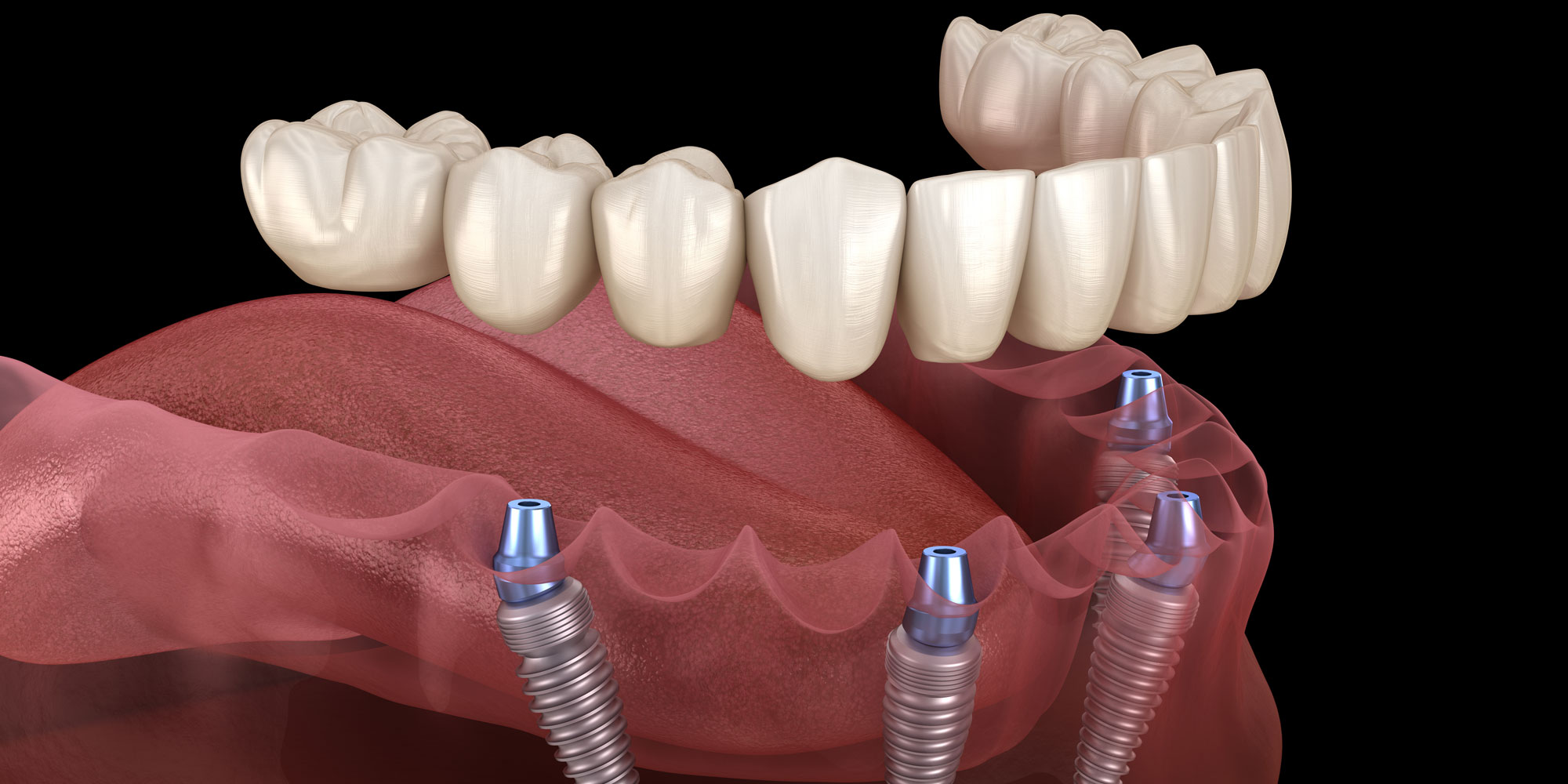 Имплантация зубов all on 6. Импланты методом all-on-6. Цифровая стоматология и имплантация.