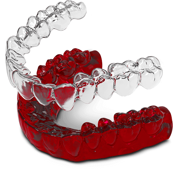 Invisalign graphic